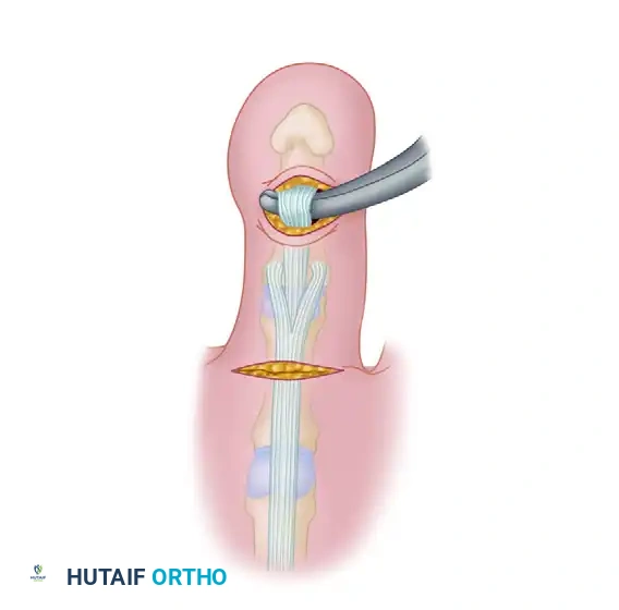FLEXOR-TO-EXTENSOR TRANSFER Surgical Diagram