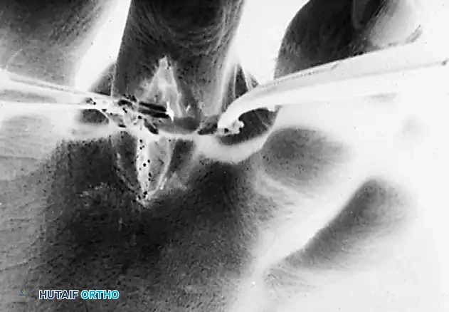 FLEXOR-TO-EXTENSOR TRANSFER Surgical Diagram