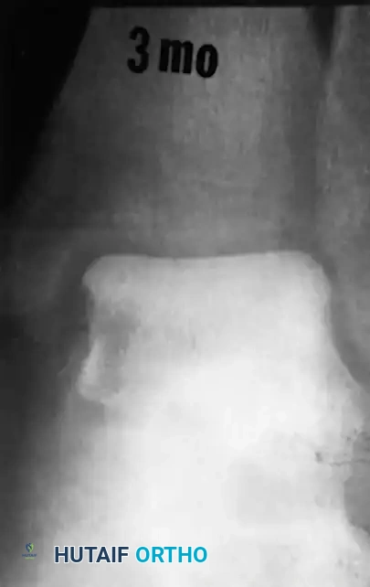 Operative Management of Talar Fractures: A Comprehensive Surgical Guide