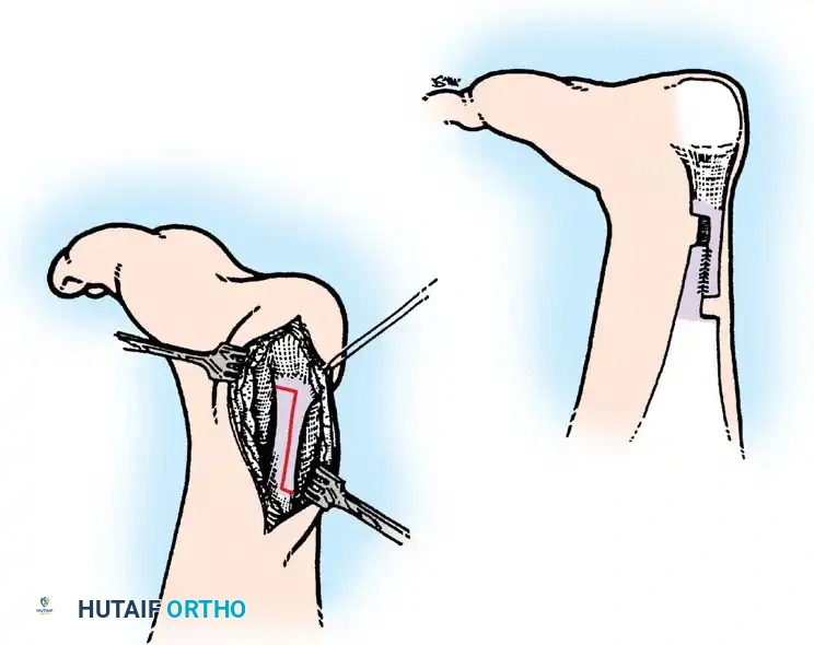التطويل الدقيق على شكل حرف زد