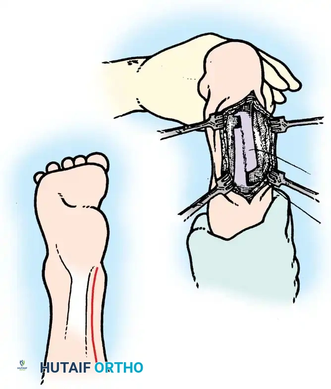 تقنية الانزلاق لتطويل وتر أخيل