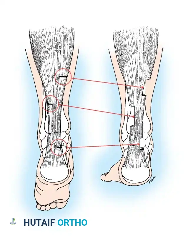 مواضع الشقوق الصغيرة للتطويل عن طريق الجلد