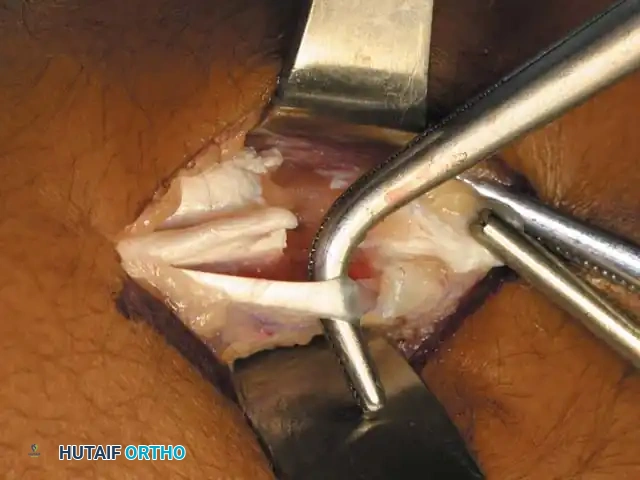 إجراء القطع الدقيق عبر الجلد