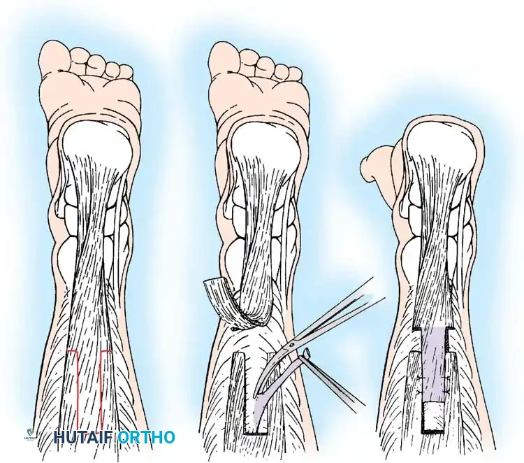 تحديد مكان القطع في اللفافة العضلية