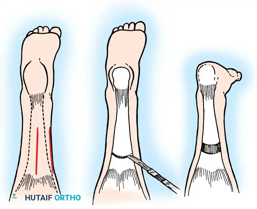 القص العظمي لتصحيح هيكل القدم