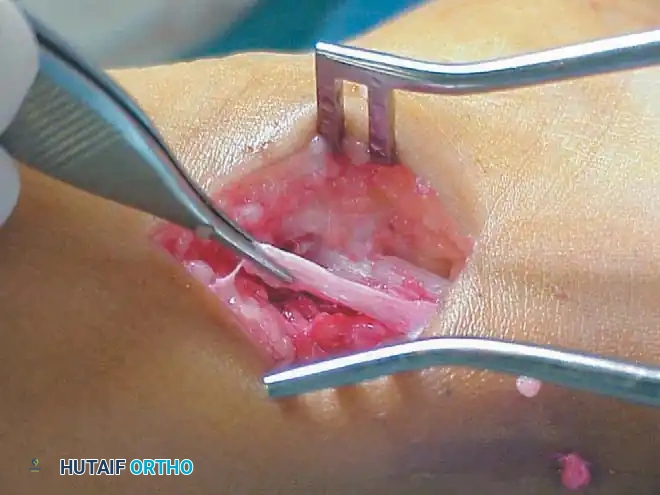 فصل الأنسجة الرخوة حول العضلة