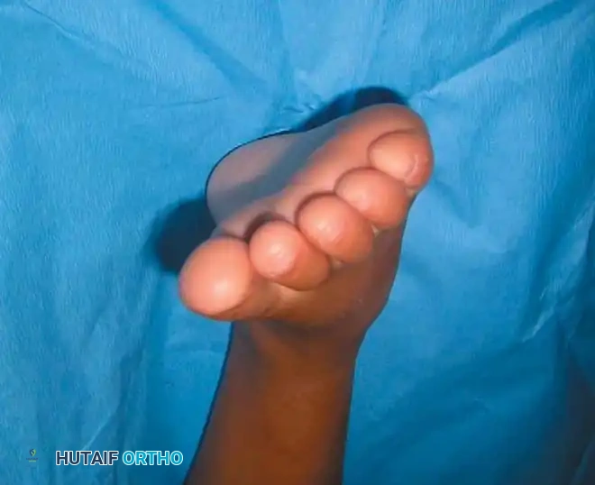 تأمين الوتر بالخيوط الجراحية