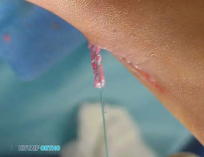 استكمال خطوات تطويل الوتر المفتوح