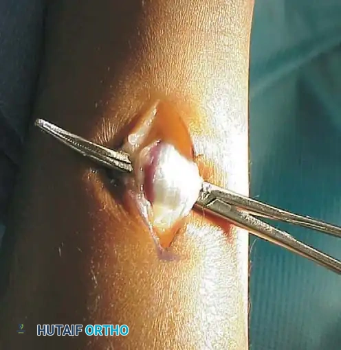 تشريح عضلة السمانة ولفافتها