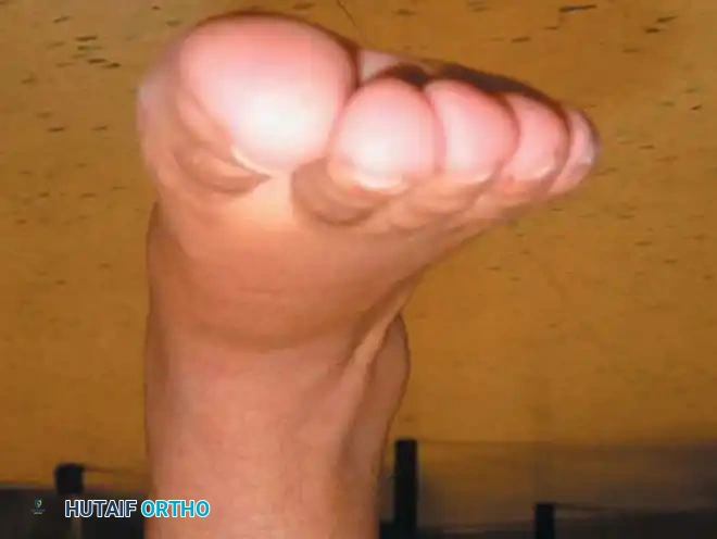 انزلاق العضلة لتحقيق الإطالة