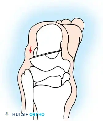 إجراء القطع العرضي في اللفافة