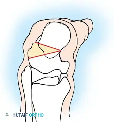تفاصيل الشق الجراحي والتعامل مع الأنسجة