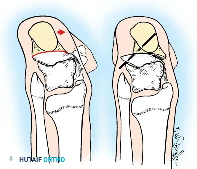 تأمين النسيج العضلي بعد الإطالة