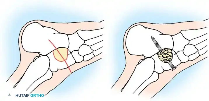 النتيجة الفورية لتحرر الوتر