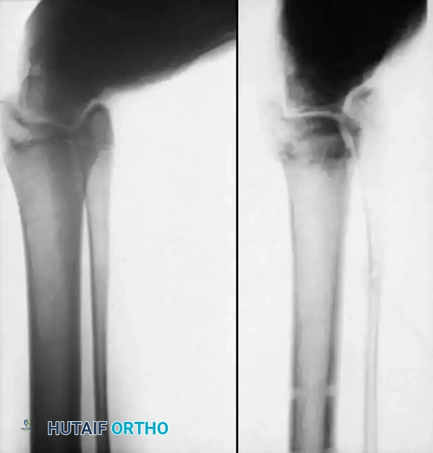 خطوات تثبيت الوتر المنقول