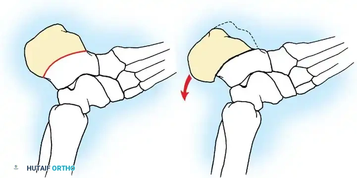 تخطيط عملية نقل الأوتار لتصحيح الانحراف