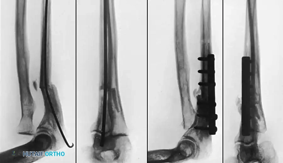 Forearm Malunions and Radioulnar Synostosis: Surgical Management