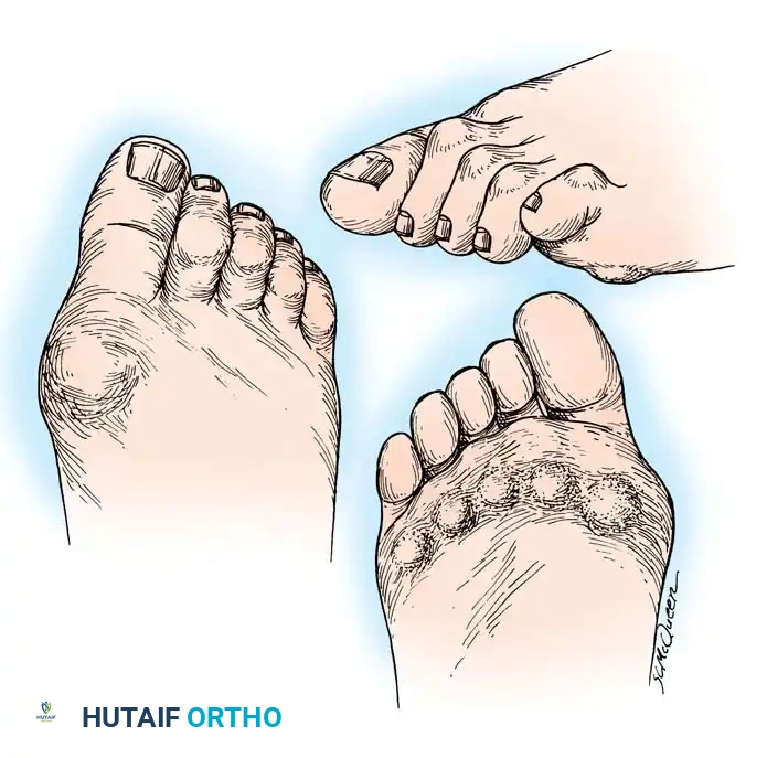 Operative Management of the Rheumatoid Forefoot: A Comprehensive Guide