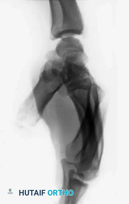 Fig. 64-31 Dislocation of fourth and fi fth carpometacarpal joints. A, Clinical appearance of hand before reduction. Note dorsoulnar hand swelling consistent with injury. B, Posteroanterior view. C, Lateral view. D, Oblique view. E and F, Traction was adequate to reduce, and splint was satisfactory to maintain reductions.