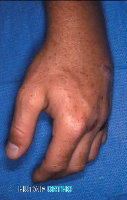 Mastering the Operative Management of the Four Medial Metacarpals