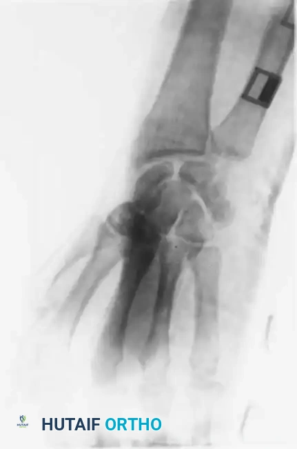 Fig. 64-31 Dislocation of fourth and fi fth carpometacarpal joints. A, Clinical appearance of hand before reduction. Note dorsoulnar hand swelling consistent with injury. B, Posteroanterior view. C, Lateral view. D, Oblique view. E and F, Traction was adequate to reduce, and splint was satisfactory to maintain reductions.