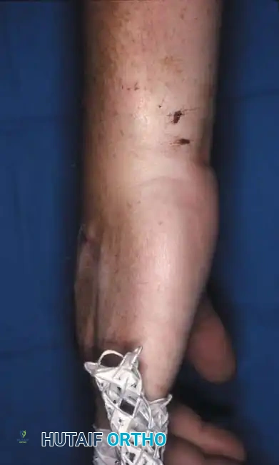 Fig. 64-31 Dislocation of fourth and fi fth carpometacarpal joints. A, Clinical appearance of hand before reduction. Note dorsoulnar hand swelling consistent with injury. B, Posteroanterior view. C, Lateral view. D, Oblique view. E and F, Traction was adequate to reduce, and splint was satisfactory to maintain reductions.