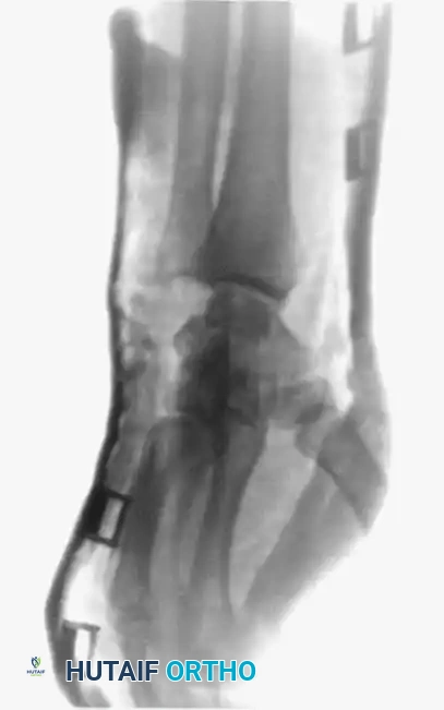 Fig. 64-31 Dislocation of fourth and fi fth carpometacarpal joints. A, Clinical appearance of hand before reduction. Note dorsoulnar hand swelling consistent with injury. B, Posteroanterior view. C, Lateral view. D, Oblique view. E and F, Traction was adequate to reduce, and splint was satisfactory to maintain reductions.