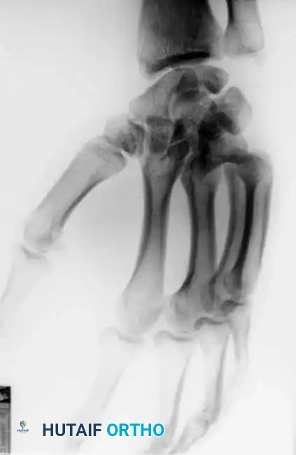 Fig. 64-31 Dislocation of fourth and fi fth carpometacarpal joints. A, Clinical appearance of hand before reduction. Note dorsoulnar hand swelling consistent with injury. B, Posteroanterior view. C, Lateral view. D, Oblique view. E and F, Traction was adequate to reduce, and splint was satisfactory to maintain reductions.