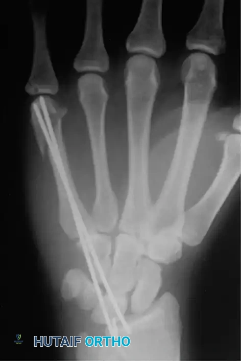 Fig. 64-37 Radiograph showing reduction and fi xation of fracture of metacarpal shaft and neck.