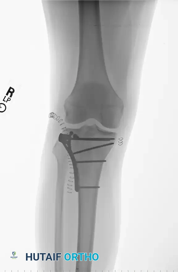 Type II Fracture-Dislocation X-Ray A