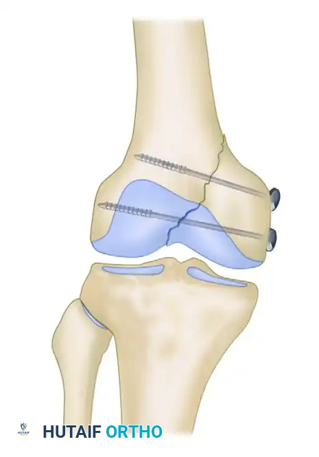 FRACTURE FIXATION OF THE MEDIAL CONDYLE Surgical Diagram