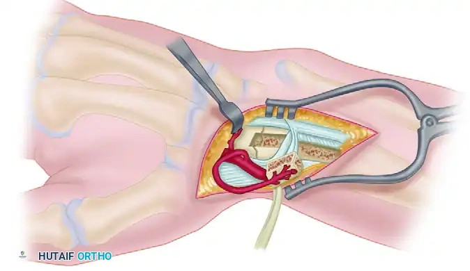 FRACTURE OF THE HAMATE Surgical Diagram