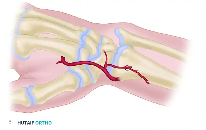 FRACTURE OF THE HAMATE Surgical Diagram