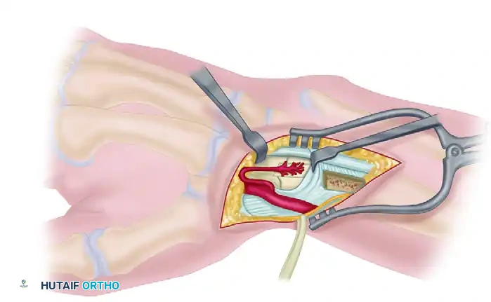 FRACTURE OF THE HAMATE Surgical Diagram
