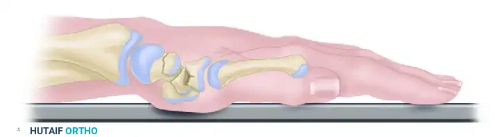 FRACTURE OF THE HAMATE Surgical Diagram