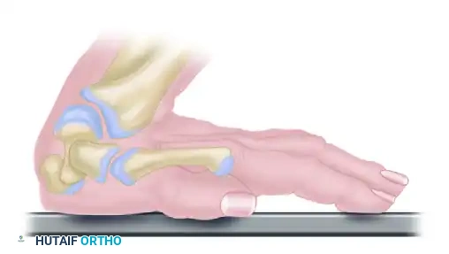 Advanced Management of Hamate Fractures and Complex Carpal Dynamics