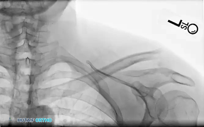 Operative Management of Shoulder Fractures: Scapula & Humerus