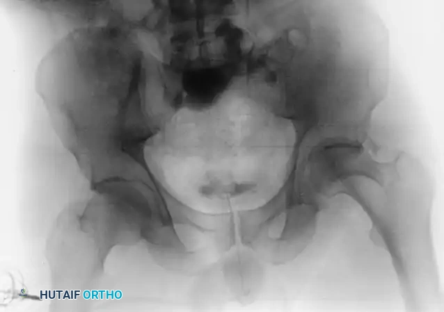 FRACTURES OF ACETABULUM AND PELVIS James L. Guyton • Edward A. Perez Surgical Diagram