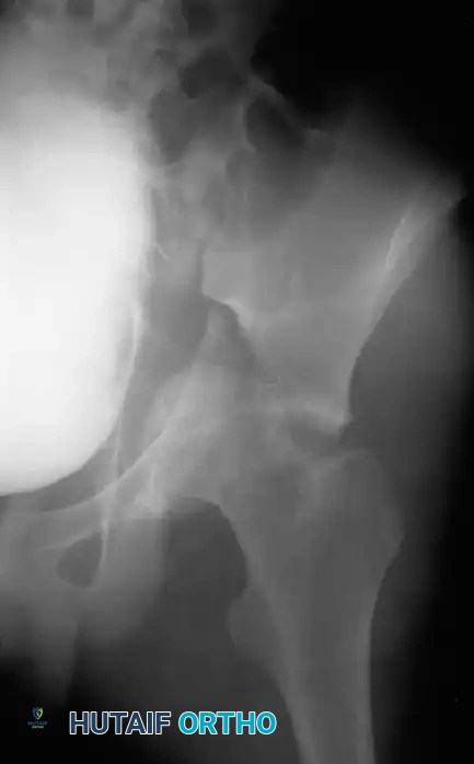 Fig. 53-3 Transverse acetabular fracture with true central fracture-dislocation; intrapelvic femoral head can become locked between superior and inferior fracture fragments.