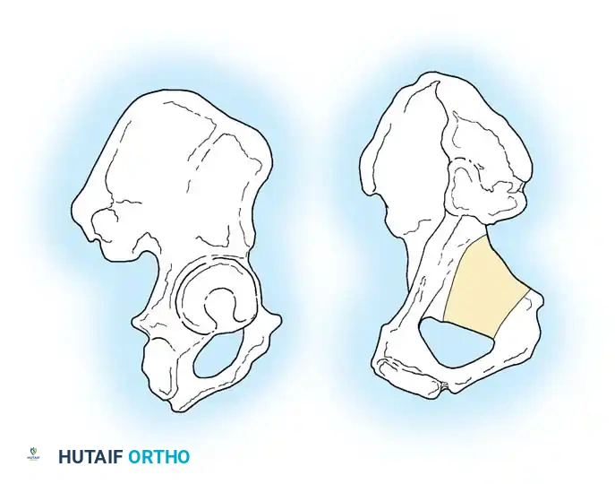 Fractures of Acetabulum and Pelvis Surgical Diagram
