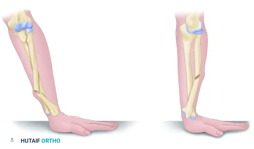 Distal Radius and Galeazzi Fractures: Principles of Operative Management