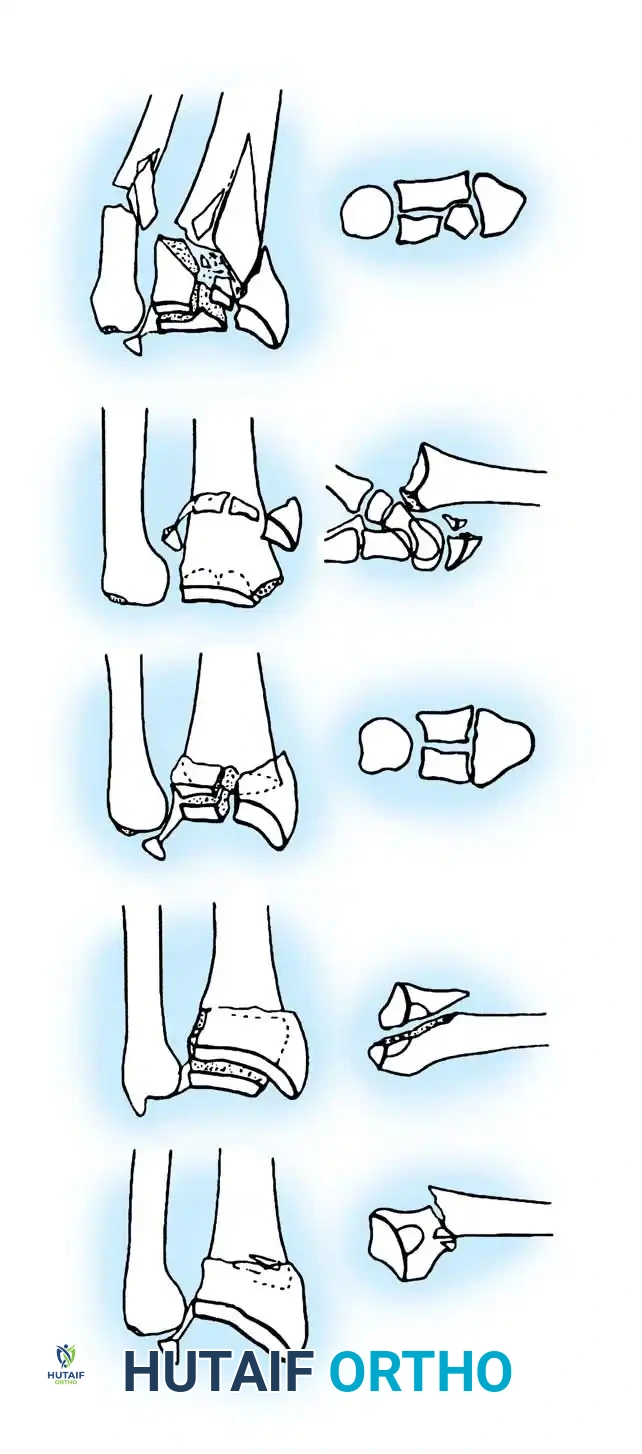 Operative Management of Distal Radius Fractures: A Comprehensive Surgical Guide