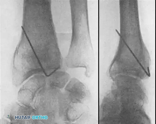 Fig. 54-103 A and B, Four-part type III distal radial fracture treated by open reduction, internal fi xation of intraarticular component, iliac bone grafting, and external fi xation. C and D, Follow-up radiographs at 5 weeks (C) and 3 years (D) show anatomical restoration of joint surface, maintenance of radial length, and absence of degenerative changes. (From Fernandez DL: Fractures of the distal radius: operative treatment, Instr Course Lect 42:73, 1993.)
