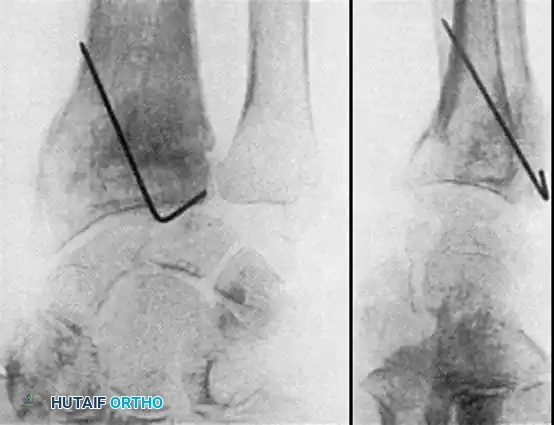 FRACTURES OF THE DISTAL RADIUS Surgical Diagram