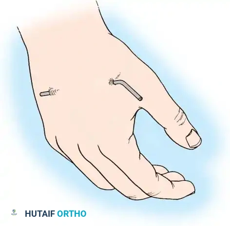 FRACTURES OF THE DISTAL RADIUS Surgical Diagram