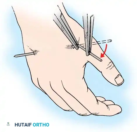 FRACTURES OF THE DISTAL RADIUS Surgical Diagram