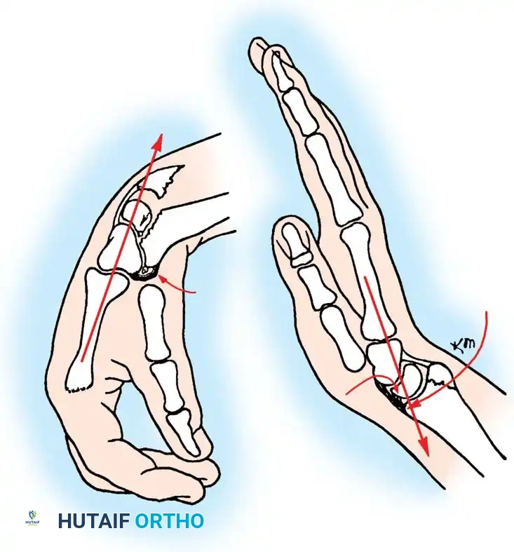 FRACTURES OF THE DISTAL RADIUS Surgical Diagram