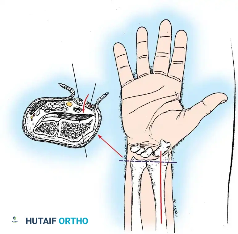 FRACTURES OF THE DISTAL RADIUS Surgical Diagram