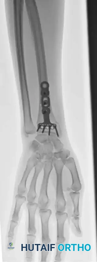 FRACTURES OF THE DISTAL RADIUS Surgical Diagram