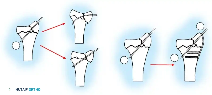 FRACTURES OF THE DISTAL RADIUS Surgical Diagram
